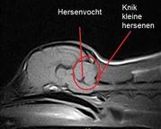 Syringomyelia
